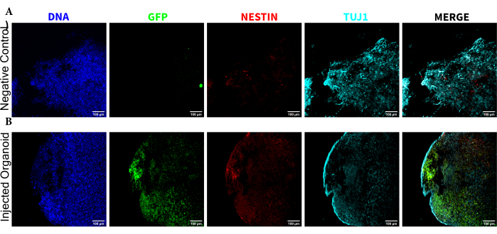 Fluorescence microscopy of organoid injection; DNA, GFP, NESTIN, TUJ1 markers; comparative analysis.