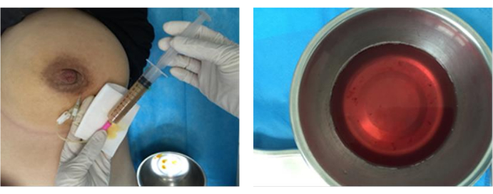 Medical procedure diagram; fluid extraction from body, syringe setup, clinical process.