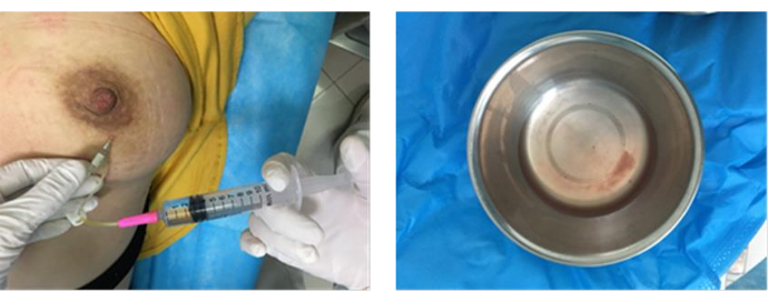 Breast milk extraction using syringe; left: syringe in use; right: collected milk in metal bowl.