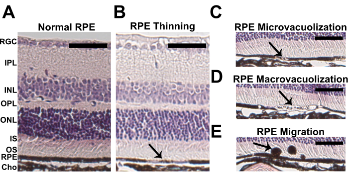 figure-results-1 Retinal pigment epithelium (RPE) histology diagram; normal, thinning, microvacuolization, migration.
