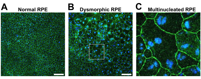 figure-results-3 RPE cell morphology comparison; normal, dysmorphic, multinucleated; microscope image; cell analysis.