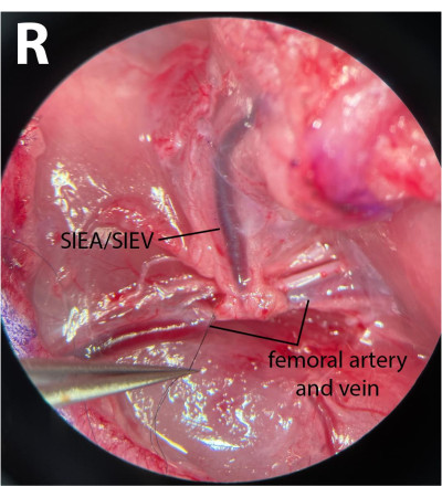 figure-protocol-3 Dissection process highlighting SIEA/SIEV and femoral artery, surgical anatomy photo.