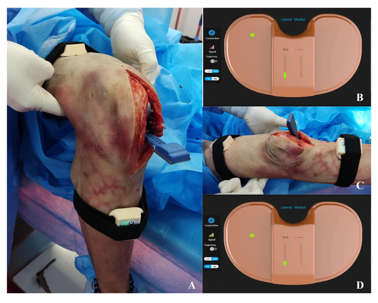 In Vitro Application of a Wireless Sensor in Flexion-Extension Gap Balance  of Unicompartmental Knee Arthroplasty