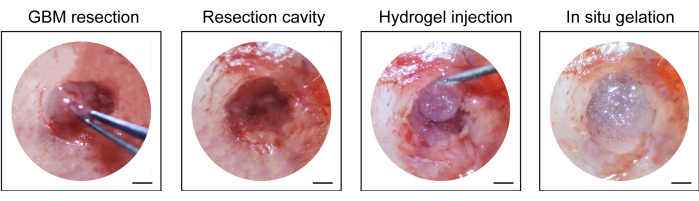 figure-results-1 GBM resection process with hydrogel injection and in situ gelation; medical procedure sequence.