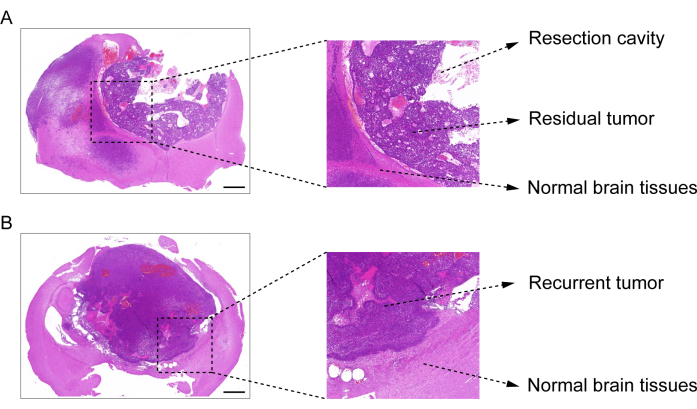 figure-results-3 Histological analysis diagram: tumor resection vs recurrence, residual and normal brain tissues.