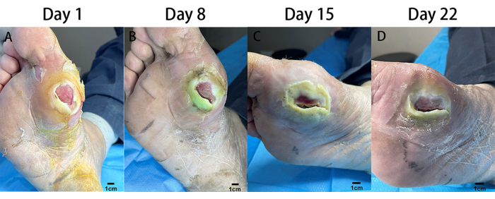 figure-results-1 Diabetic foot ulcer healing over 22 days; clinical progression images with measurement scale.