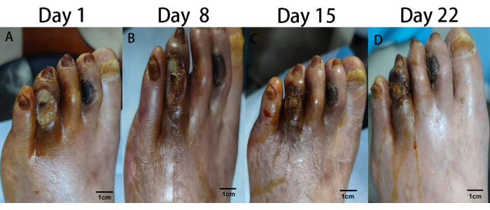 figure-results-2 Healing process of a foot wound over time; Day 1 to 22; medical progression analysis.