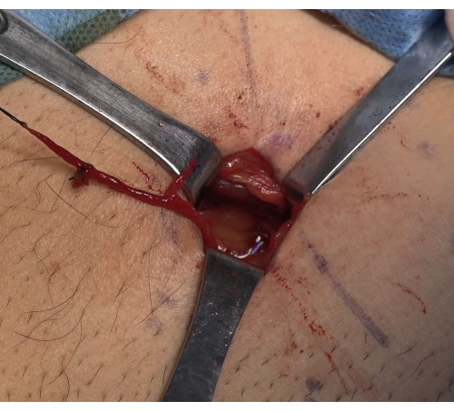 figure-results-1 Surgical procedure incision displaying tissue exposure with retractors, indicating medical technique.