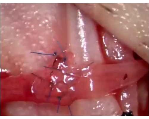 figure-results-3 Surgical suturing technique with stitches on tissue, close-up medical procedure demonstration.