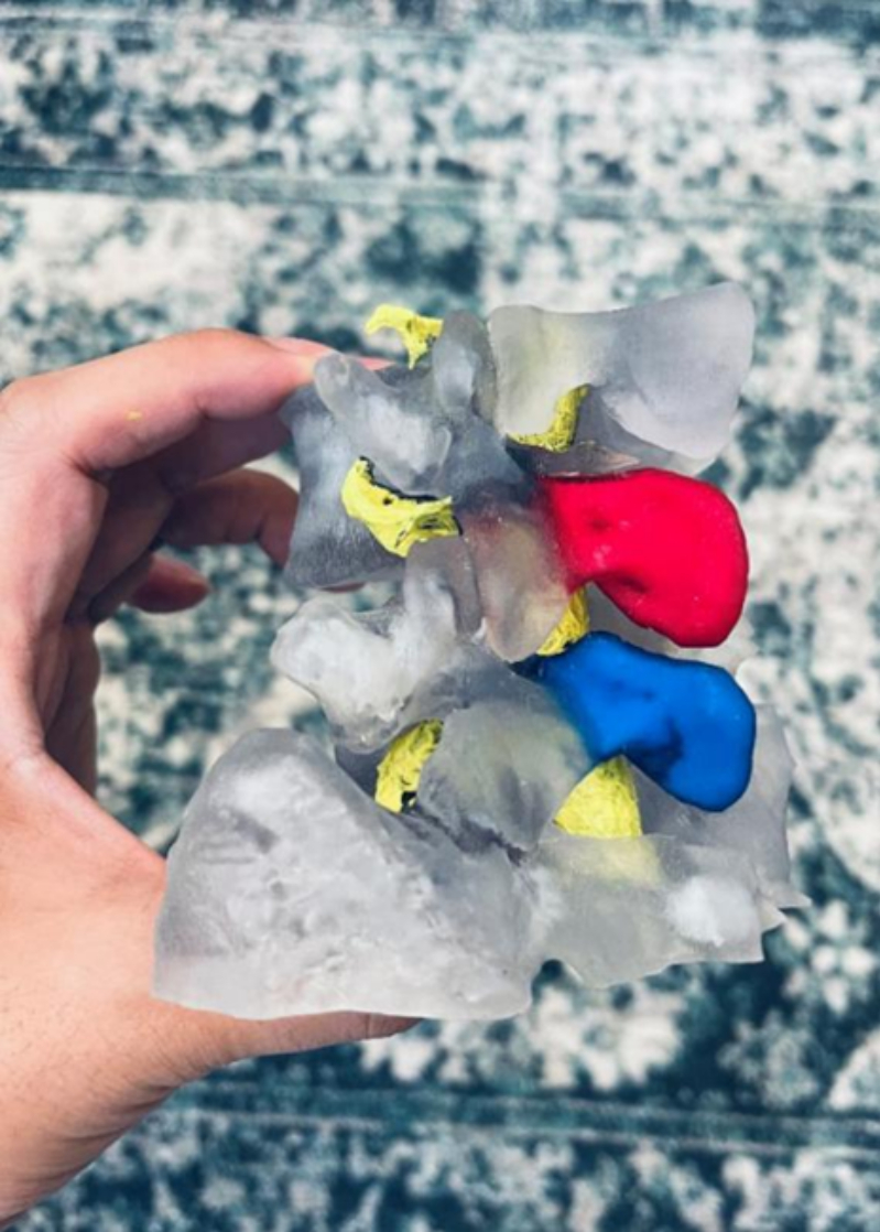 3D Printing Model of a Patient's Specific Lumbar Vertebra