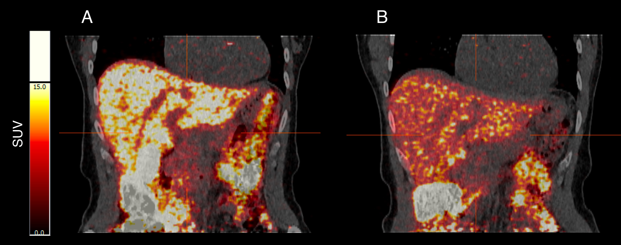 Positron Emission Tomography Using 64-Copper as a Tracer for the Study ...