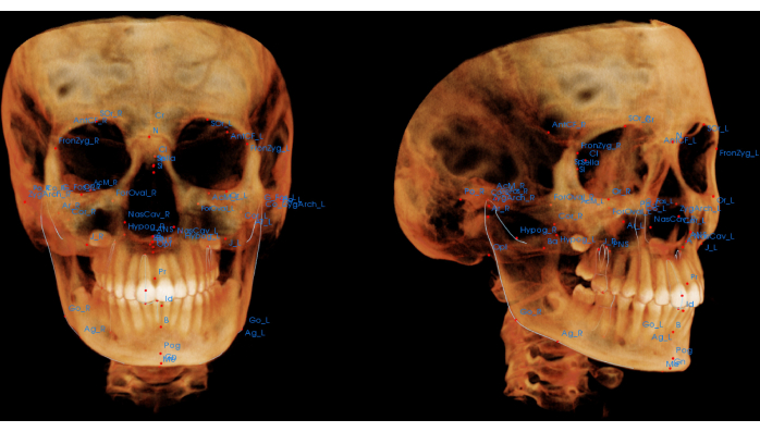 figure-results-1 3D cranial structure with labeled anatomical landmarks; CT scan visualization, biometrics study.