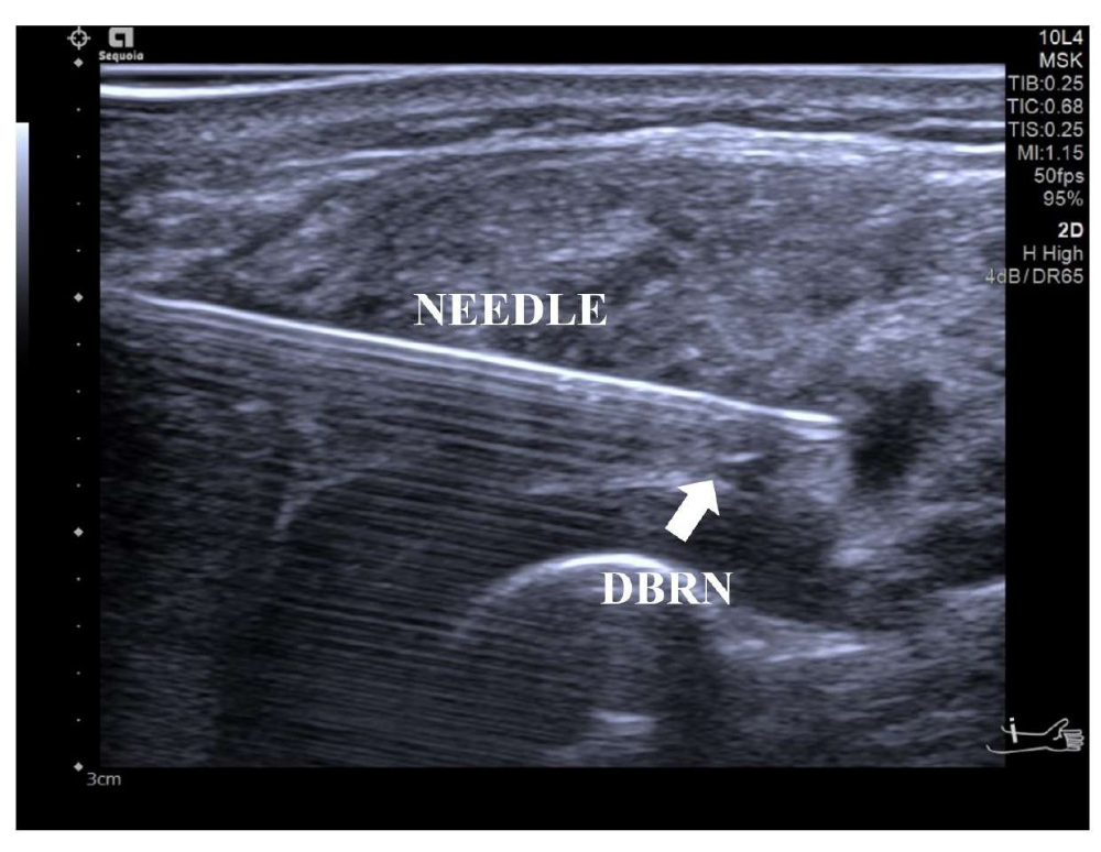 Supinator Injection Video: Author Spotlight: Ultrasound-Guided Needle Release Combined with ...