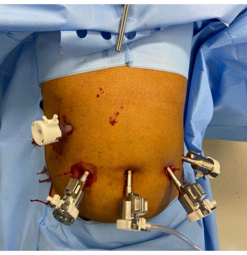 Minimally invasive surgery setup, laparoscopic instruments, abdominal trocar placement.