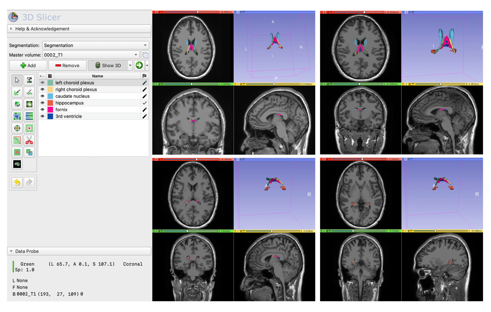 Manual Segmentation of the Human Choroid Plexus Using Brain MRI | Text Page
