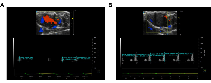 figure-results-2 Ultrasound Doppler scan; heart blood flow; diagram; velocity analysis; cardiovascular study.