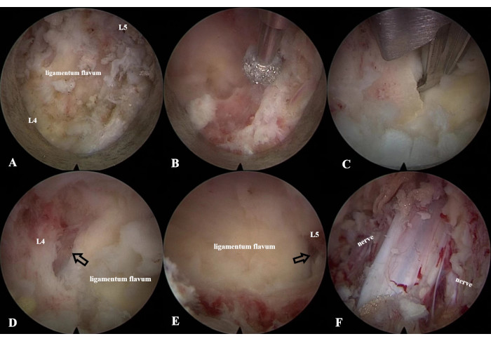 figure-results-4 Endoscopic spine surgery; ligamentum flavum removal; nerve visualization; medical procedure steps.