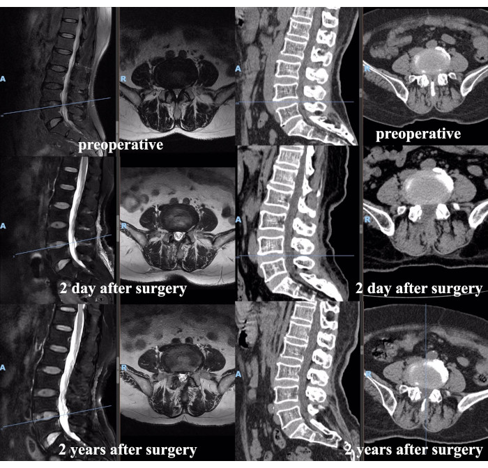 figure-results-5 MRI and CT spine images show preoperative, 2-day, and 2-year post-surgery stages in spinal examination.