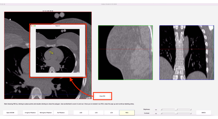 CT scan analysis diagram; computer-assisted planning, cross-sectional imaging, coronary artery tracing.