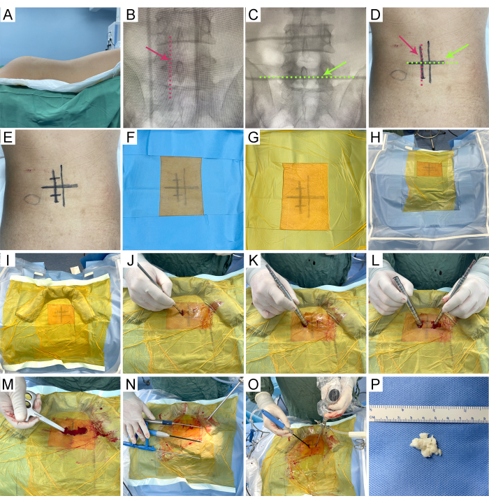 Surgical procedure sequence; spine imaging and incisions; vertebral biopsy result; medical diagram.