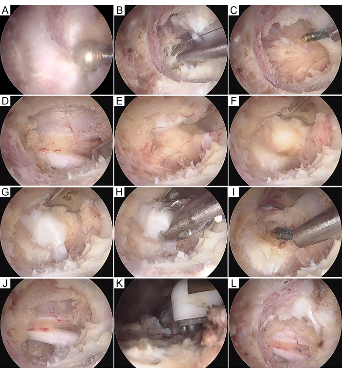 Arthroscopic surgery sequence, joint repair technique, medical procedure visualization, step-by-step.