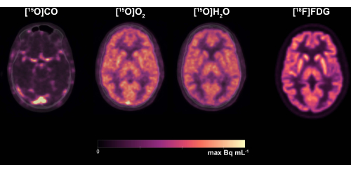PET scan showing brain activity with [15O]CO, [15O]O2, [15O]H2O, [18F]FDG tracers; results comparison.