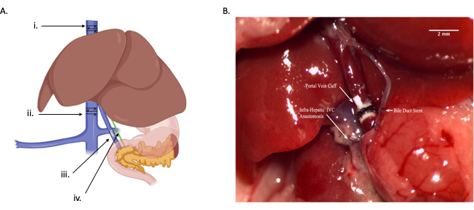 figure-results-1 Liver anatomy diagram and surgical image; portal vein, bile duct, intra-hepatic IVC anastomosis.