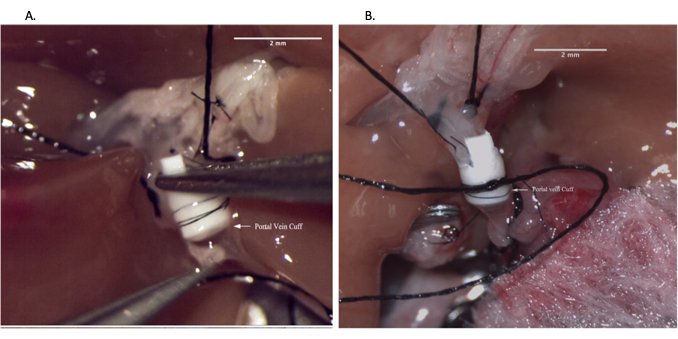 figure-results-6 Surgical technique with portal vein cuff in microsurgery; detailed procedural image.