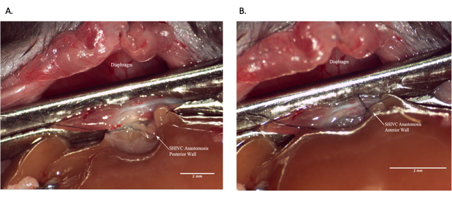 figure-results-7 Surgical anastomosis technique; diaphragm labeled, SIVVC anastomosis; medical surgery process.