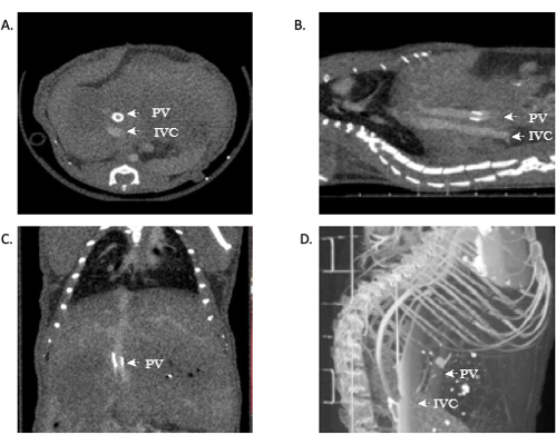figure-results-11 CT scan images showing liver anatomy with labeled portal vein (PV) and inferior vena cava (IVC).
