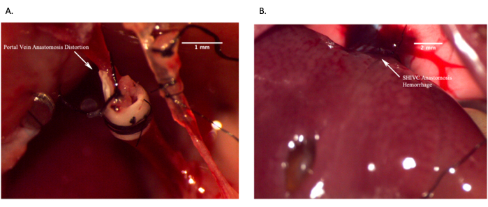 figure-results-12 Surgical anastomosis images: Portal vein distortion, SHIVC hemorrhage, scale indicators included.