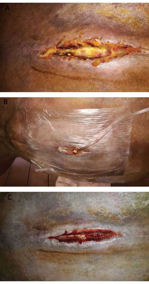 figure-results-1 Surgical wound healing process; shows three stages of recovery in a clinical study diagram.