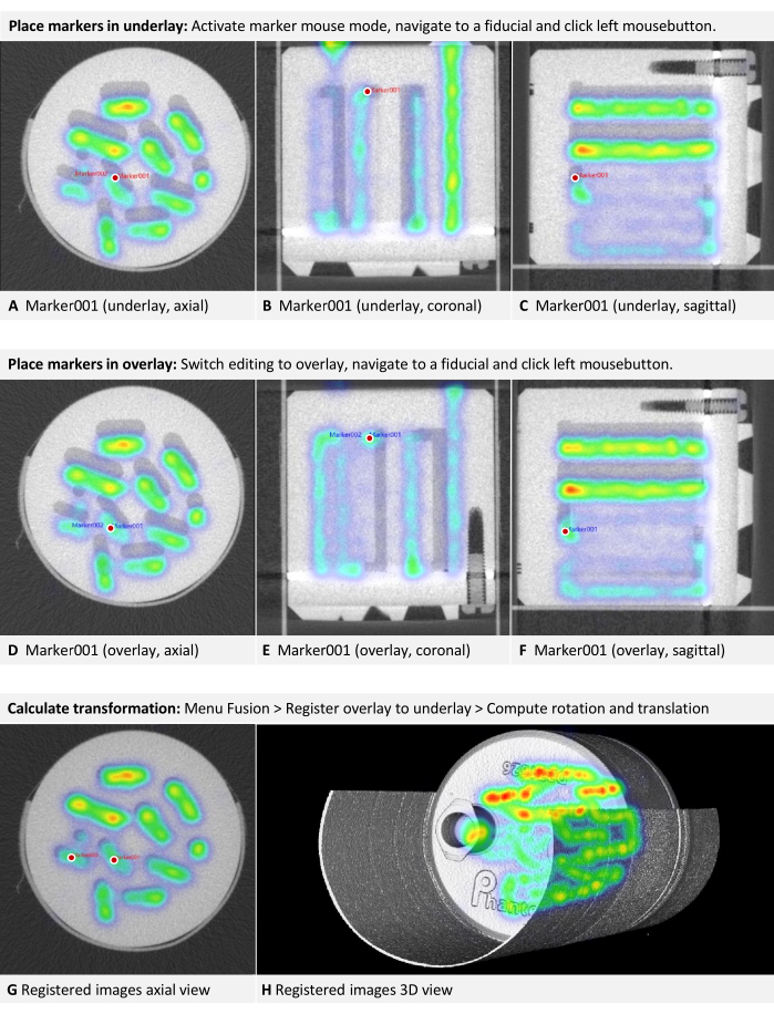 Medical imaging registration process; axial, coronal, sagittal views; overlay and transformation.