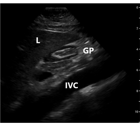 figure-results-3 Ultrasound diagram showing anatomy: liver (L), gallbladder (GP), inferior vena cava (IVC).