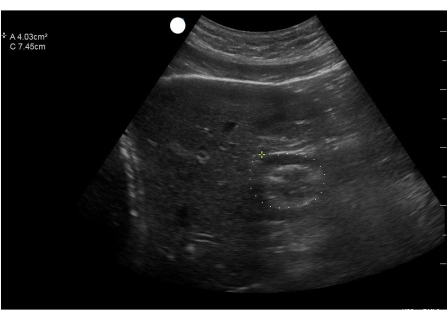 figure-results-6 Ultrasound imaging, medical diagnostic, liver examination, grayscale, measurement data, healthcare.