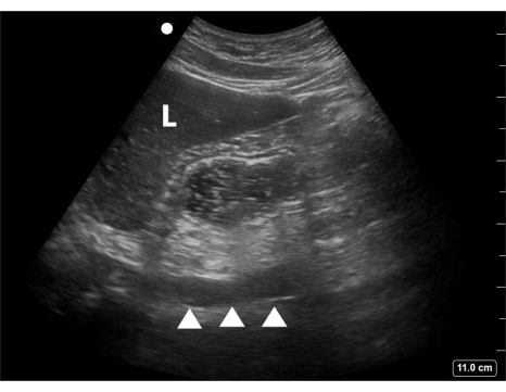 figure-results-10 Ultrasound image showing abdominal ultrasound procedure with labeled internal structures for diagnostic use.