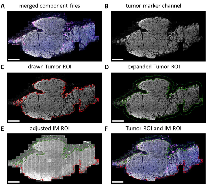 figure-results-5 Tumor imaging analysis process; diagram of merged files, tumor channels, ROI adjustments.