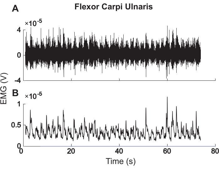 EMG signal analysis graph for flexor carpi ulnaris muscle, showing voltage vs time traces.