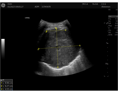 A Stepwise Approach for Performing Ultrasound Guided Transthoracic Lung ...