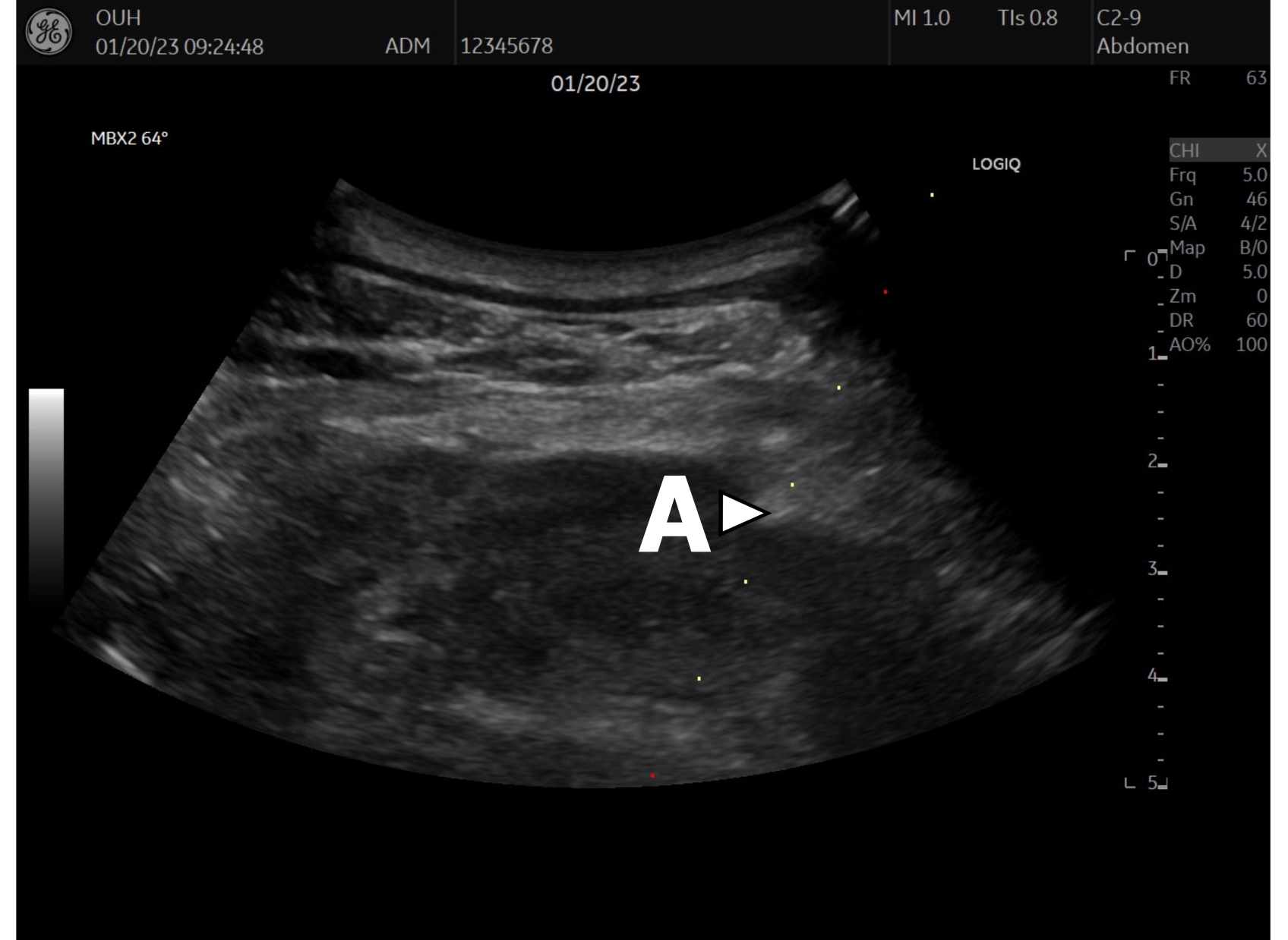 A Stepwise Approach for Performing Ultrasound Guided Transthoracic Lung ...