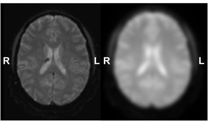 MRI brain scan comparison, T1 vs T2-weighted images, structural analysis, diagnostic assessment.
