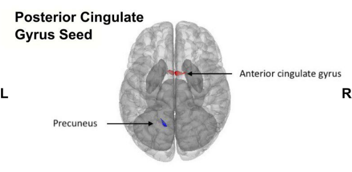 Brain connectivity diagram; posterior cingulate gyrus seed with anterior cingulate; anatomical study.