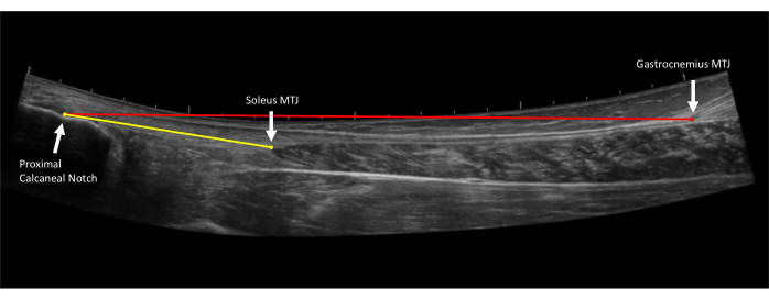 Ultrasound image of Achilles tendon, showing muscle-tendon junction and calcaneal notch for analysis.