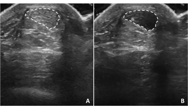 Ultrasound imaging showing comparative analysis of tissue sections, highlighting specific regions.