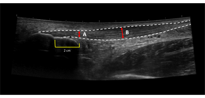 Ultrasound image showing muscle tissue layers, annotations A and B, with scale measurement.