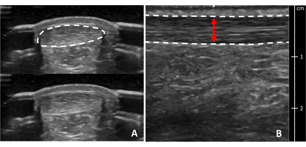 Ultrasound imaging; diagram of soft tissue thickness; measurements for anatomical analysis.