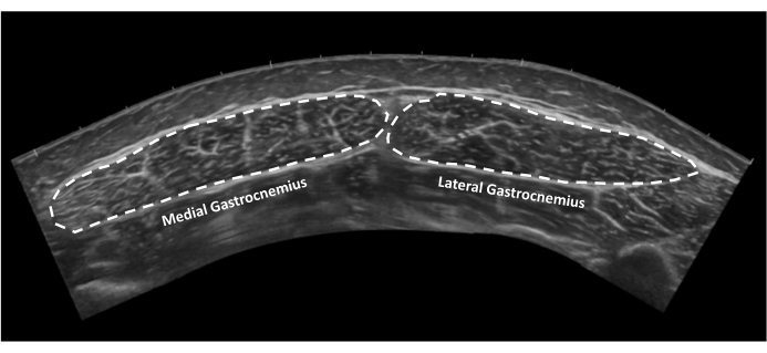 Ultrasound image; medial and lateral gastrocnemius muscles labeled; anatomy study; muscle identification.