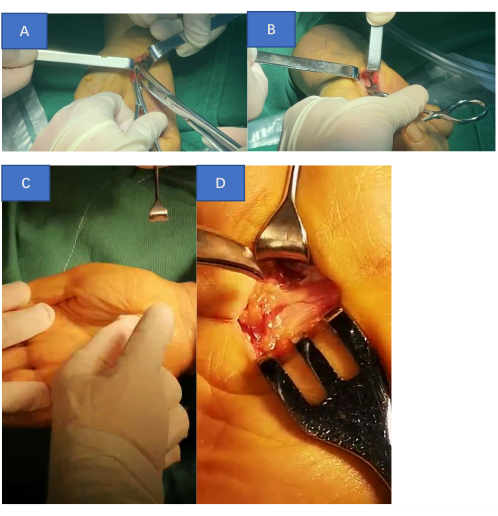 Surgical procedure diagram; hand operation, incisions, dissection stages, orthopedic surgery steps.