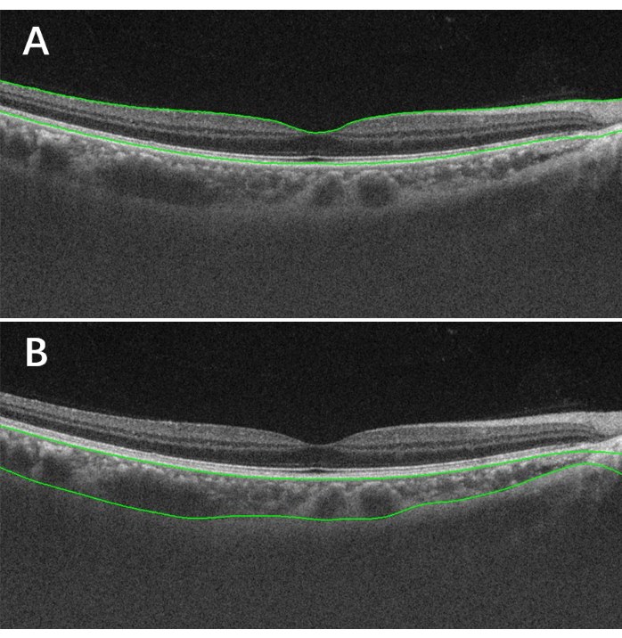 Retinal OCT images, comparison of layers; A shows swelling, B shows normal; diagnostic analysis.