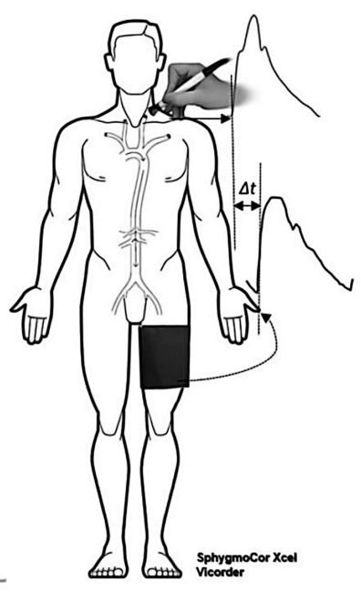Pulse wave velocity measurement, diagram with arterial path using SphygmoCor Xcel Vicorder, Δt timing.